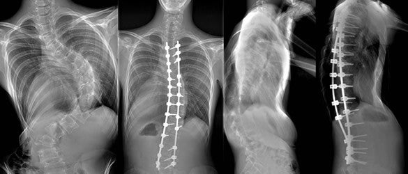 Scoliosis and Chiropractic Care